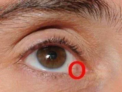 Cirurgia dos olhos para voltar enxergar
