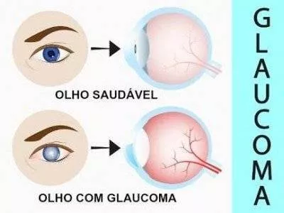 Cirurgia de Glaucoma do Valter 3JVRd