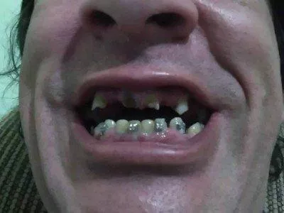 Meus Dentes